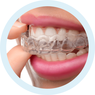 img invisalign anwendung step 2