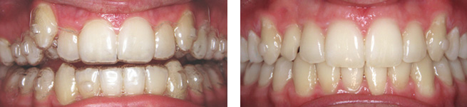 vergleich invisalign 1